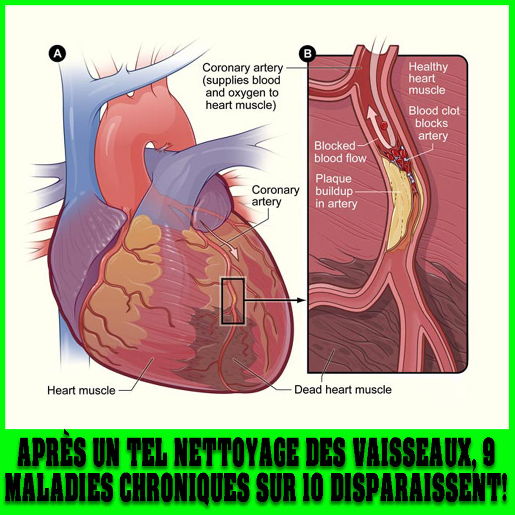 APRÈS UN TEL NETTOYAGE DES VAISSEAUX, 9 MALADIES CHRONIQUES SUR 10 DISPARAISSENT!